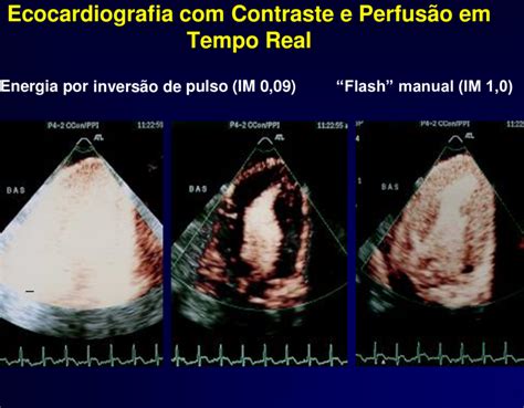 Exemplo De Ecocardiografia Contraste Mioc Rdico E Perfus O Em