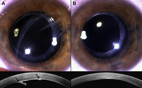 Repair Of Forceps Induced Descemets Rupture With Descemets Membrane