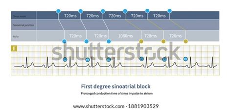 First Degree Sinoatrial Block Ecg Can Stock Illustration 1881903529