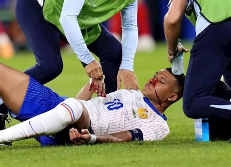 Nase Kylian Mbappe verletzt So geht es jetzt für ihn und Frankreich