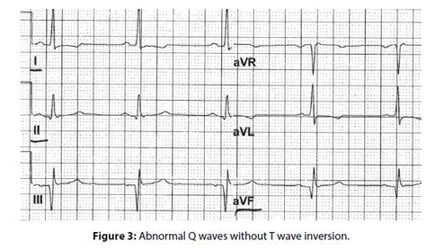 Predictive value of q waves in inferior leads for the diagnosis o