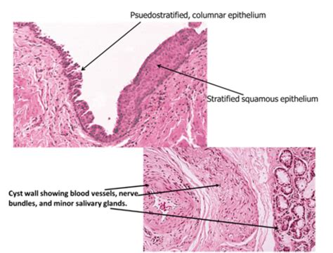 Nasopalatine Duct Cyst Histology