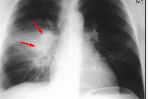 Tuberculosis Series Physical Manifestations Of Tb Infection Ethnomed