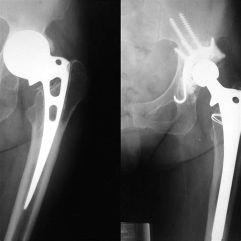 Austinemoore Prosthesis Protrusio With Acetabular American Academy Of