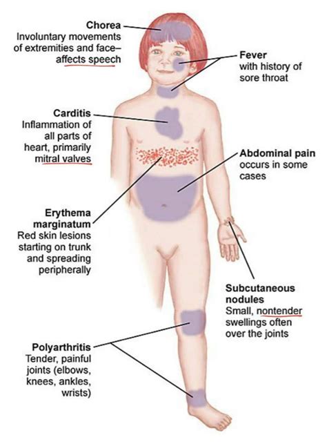 Rheumatic Fever Diagram Quizlet