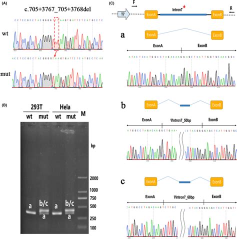 Results Of The Minigene Splicing Assay A Sanger Sequencing Of