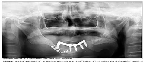 Figure 1 From Mandibular Reconstruction Using Free Vascularized Iliac Crest Grafts And Dental