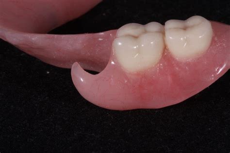 Resin Based Partials Williams Dental Lab