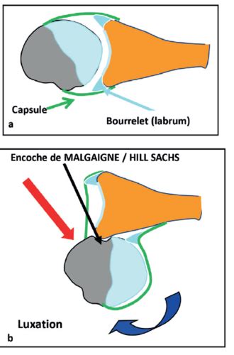 Item 361 2 Lésions péri articulaires de l épaule Flashcards Quizlet