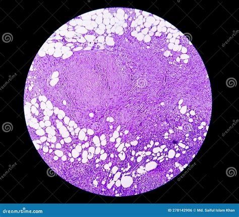 Photomicrograph Of Granulomatous Tissue Histology Stock Photo Image