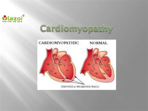 Ppt Cardiomyopathy Causes Symptoms Types Diagnosis And Treatment