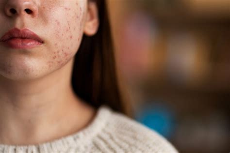 What Is Acne And How To Treat It