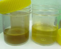 Protein in urine: Causes & Risk factors | Men's Health articles ...