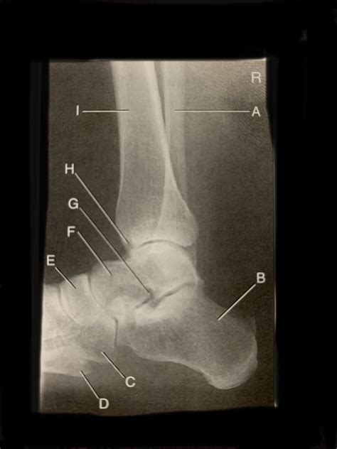 Lower Limb Lateral Ankle Right Diagram Quizlet