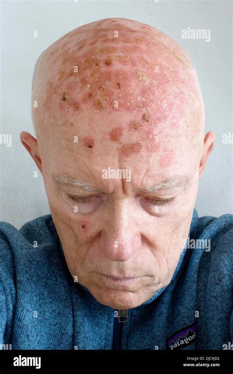 Hombre Paciente Cabeza Calvo Cara Con Da O Ligero Queratosis