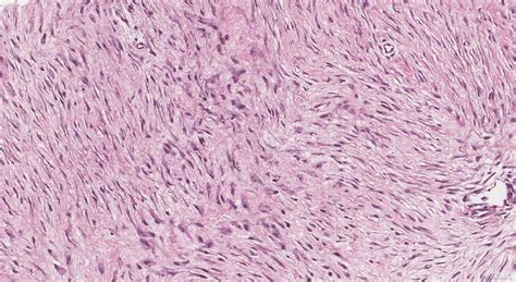 Desmoid fibromatosis | Ottawa Atlas of Pathology