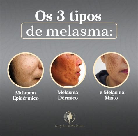 Qual A Causa Do Melasma Dra Juliana Ruthes Martines