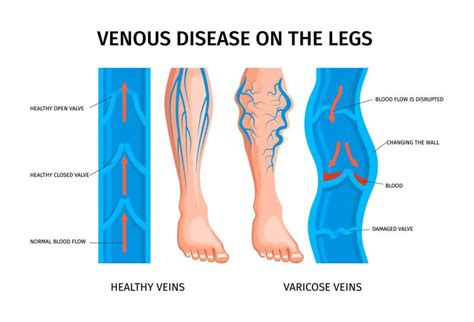 chronic venous insufficiency nexgen orthopedics