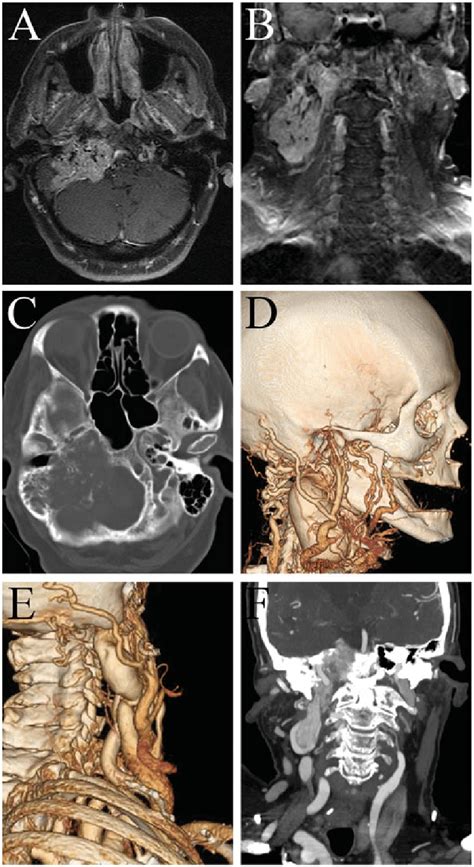 MRI of the brain with and without contrast of a large paraganglioma... | Download Scientific Diagram