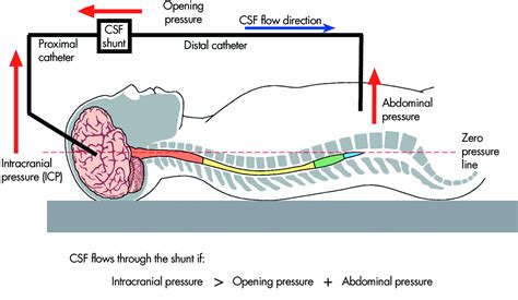 Idiopathic Normal Pressure Hydrocephalus Practical Neurology