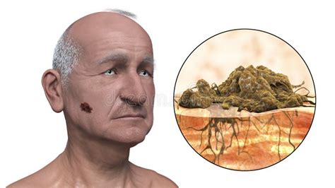 Melanoma on face skin stock illustration. Illustration of morphology ...