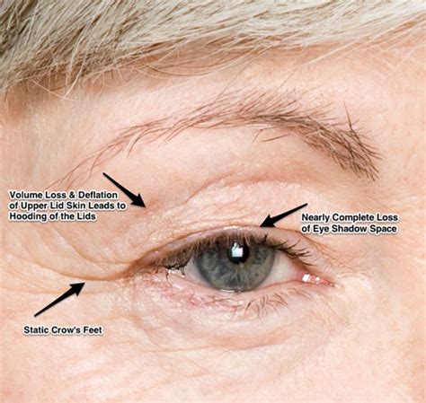 Area Between Eyelid And Eyebrow Eyebrowshaper