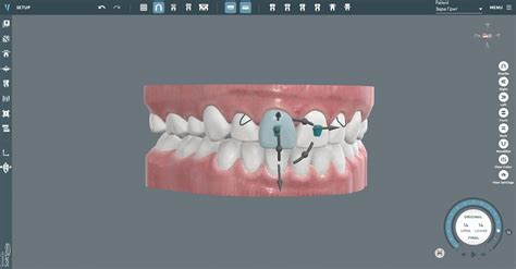 Dental 3D Modeling Software | Orthodontic CAD Software