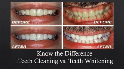 Whats The Difference Between Teeth Cleaning And Teeth Whitening I