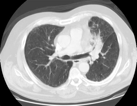 Lung Cancer Mri