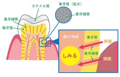 知覚過敏について｜赤羽歯科「川口診療所」