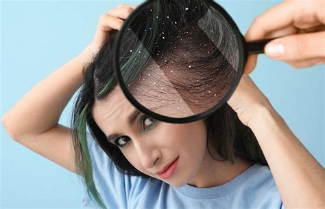 How To Get Rid Of Dandruff Naturally 18 Tips And Remedies Artofit