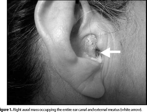 Figure 3 from Middle Ear Carcinoma Masquerading as an Aural Polyp ...