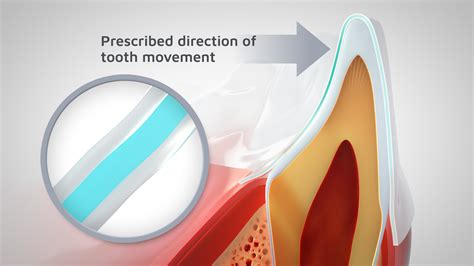 ClearCorrect® Aligners – ClearCorrect Support