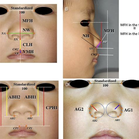 Surgical Procedures For One Stage Lip Repair For Bilateral Cleft Lip Download Scientific