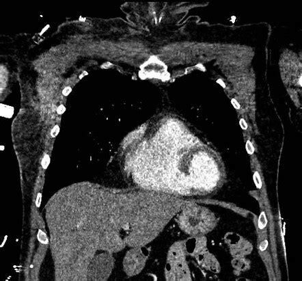 Ventricular Septal Defect After Myocardial Infarction Image