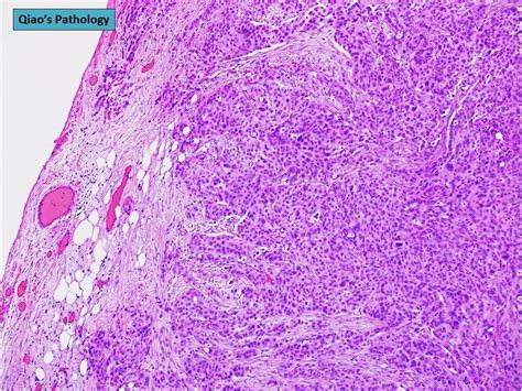 Qiaos Pathology Primary Peritoneal Serous Carcinoma A Photo On