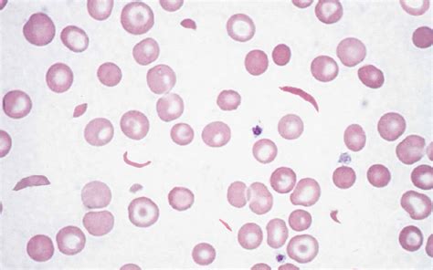 Sickle Cell Disease