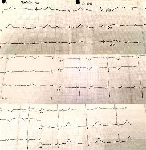 Complete Heart Block In Neonatal Lupus A Forgotten Cause Of Fetal