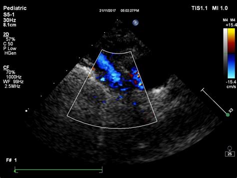 Bi directional Glenn shunt – SujyotHeartClinic