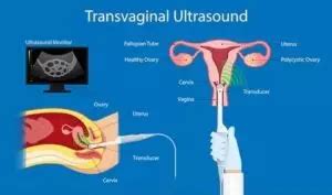 O Que É Transvaginal - Ultrassom transvaginal: o que é, para que serve e quando fazer - Med