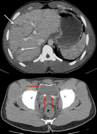 Axial CT image of the liver shows multiple peripheral subcapsular and