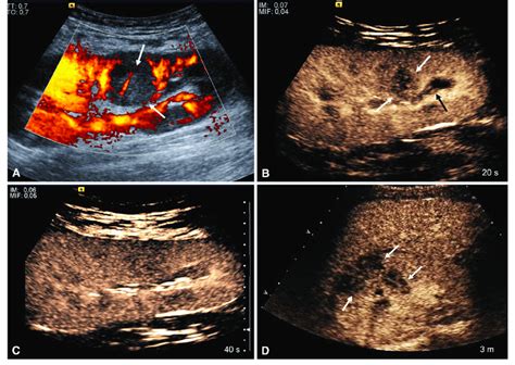 Focal Pyelonephritis A C 17 Year Old Female Transplant Recipient A Download Scientific