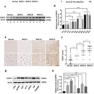 Copz Expression Is Elevated In Primary Human Glioma Samples And Gbm