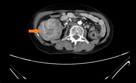 Frontiers Case Report An Adult Intussusception Caused By Ascending