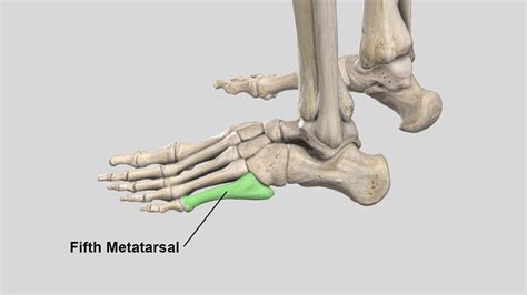 5th Metatarsal Fracture - Motus Physical Therapy