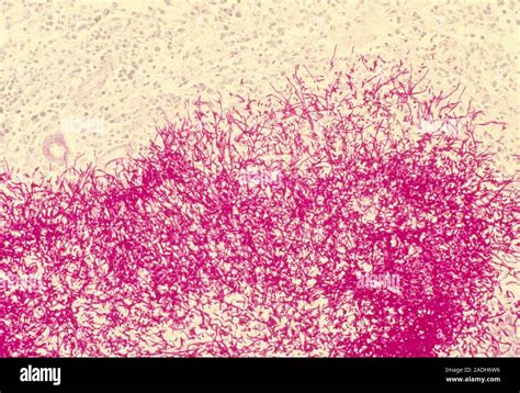 aspergillosis light micrograph   section  human kidney infected