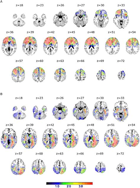 Lesion Distribution Volume Map For A Frontal And B Non Frontal