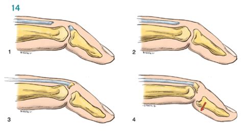 Clin Med MSK Classifications Flashcards Quizlet