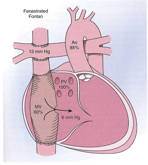 Fontan Procedure