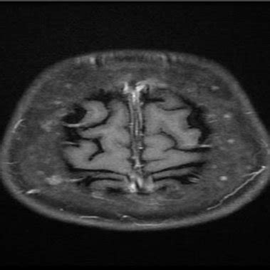 Axial T1 Contrast Image Thickened Calvarium With Widened Diploic